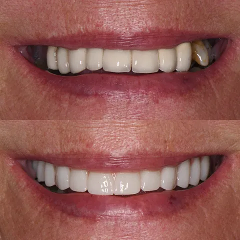 Före och efter tandimplantat – naturligt resultat hos patient i Stockholm